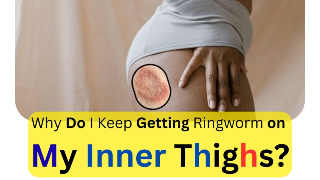 Why do I keep getting ringworm on my inner thighs? Best Solution