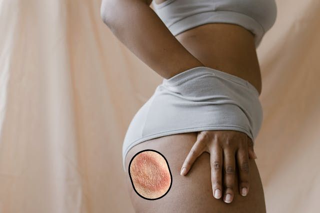 Why do i keep getting ringworm on my inner thighs?