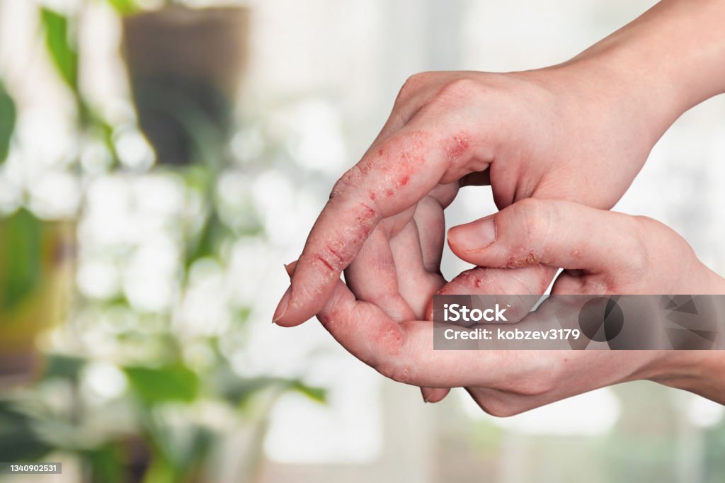 Sores in the gaps between the toes are a common enough skin problem, yet one that is often overlooked. A lot of individuals suffer through itchy skin, redness, or even very painful splits in the skin on the hands, but ignore it until it is far too late. how long does a hand infection take to heal?