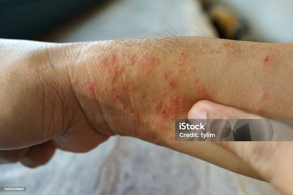 Sores in the gaps between the toes are a common enough skin problem, yet one that is often overlooked. A lot of individuals suffer through itchy skin, redness, or even very painful splits in the skin on the hands, but ignore it until it is far too late. how long does a hand infection take to heal?