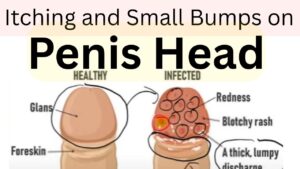 Why does itching and small bumps occur on the penis head? Best Solution.