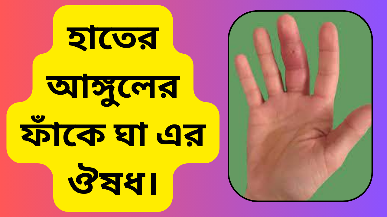 হাতের আঙ্গুলের ফাঁকে ঘা এর ঔষধ। 100% Best and Genuine. 5 হাতের আঙ্গুলের ফাঁকে ঘা এর ঔষধ।