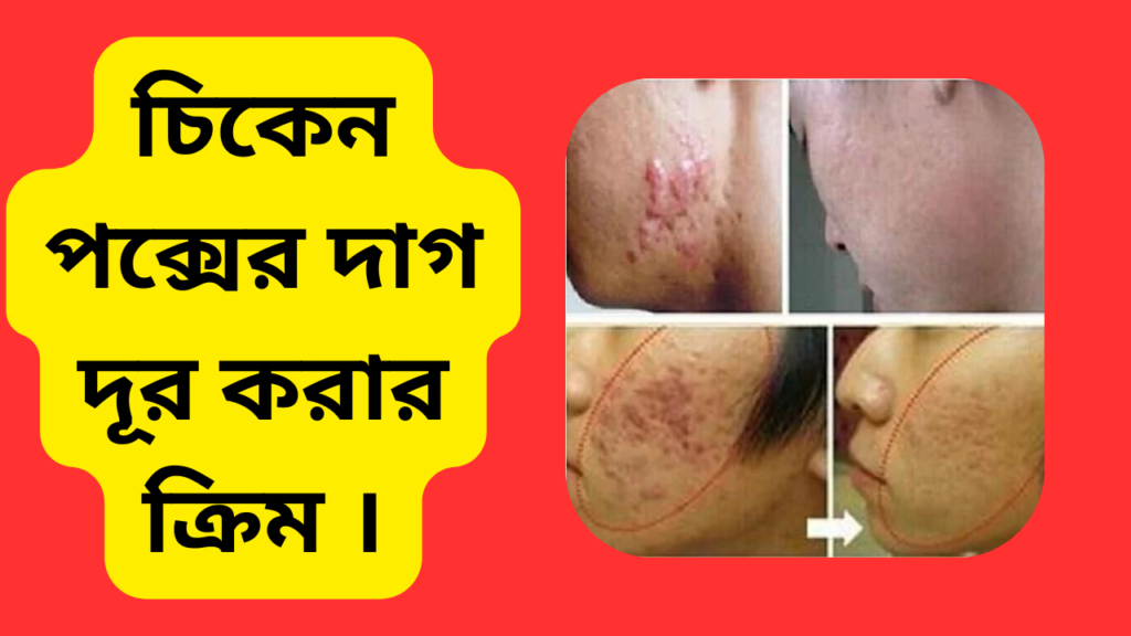 চিকেন পক্সের দাগ দূর করার ক্রিম ।